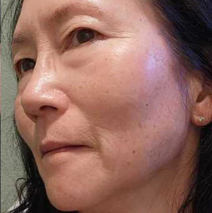 Close-up of a person's face with visible skin texture and purple discoloration.